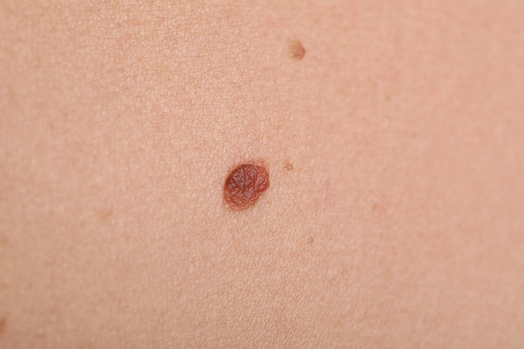 Close-up of a mole with an irregular shape, uneven borders and varied pigmentation.