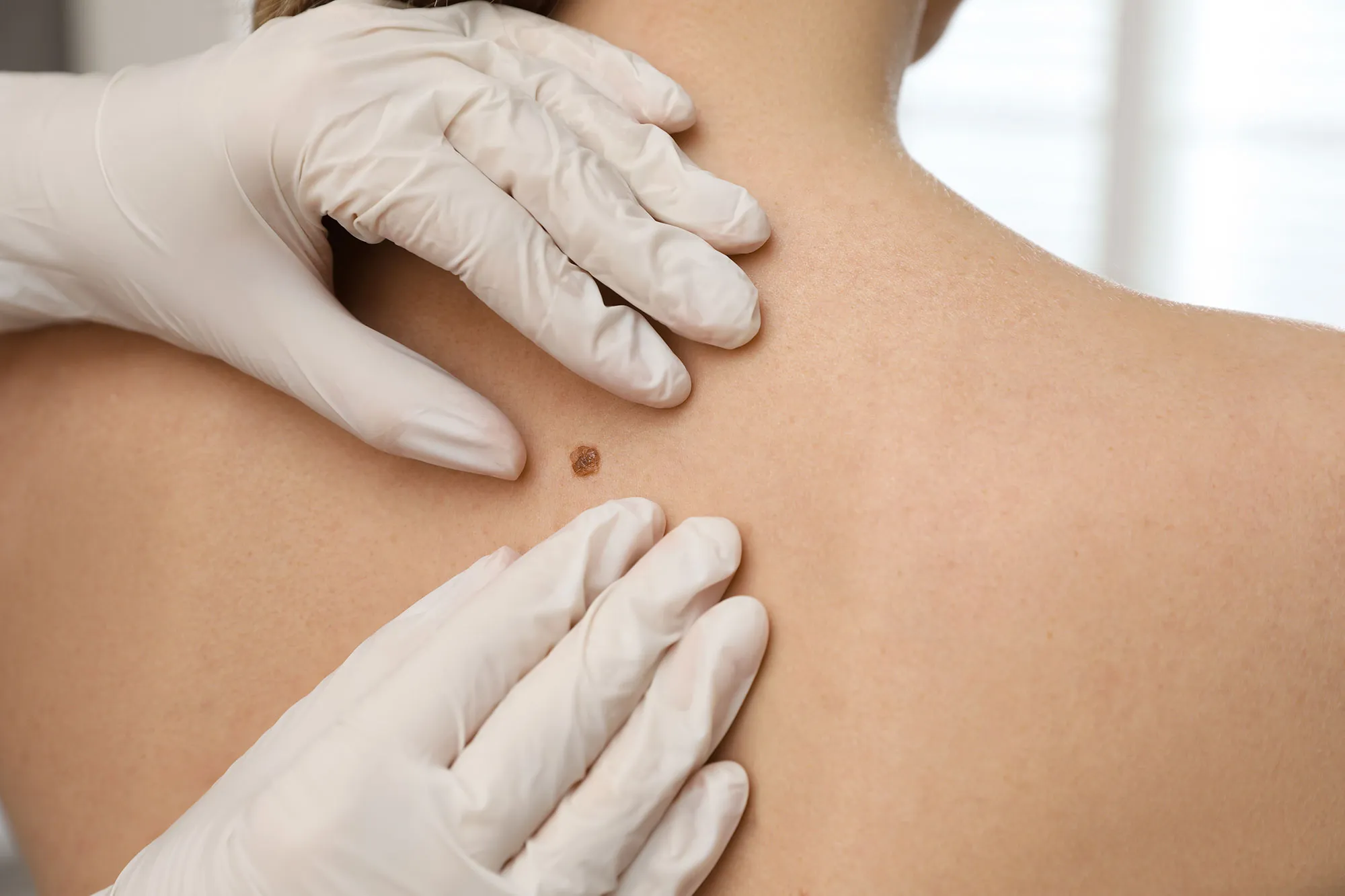 Oncology surgeon examining a patient's suspicious mole.