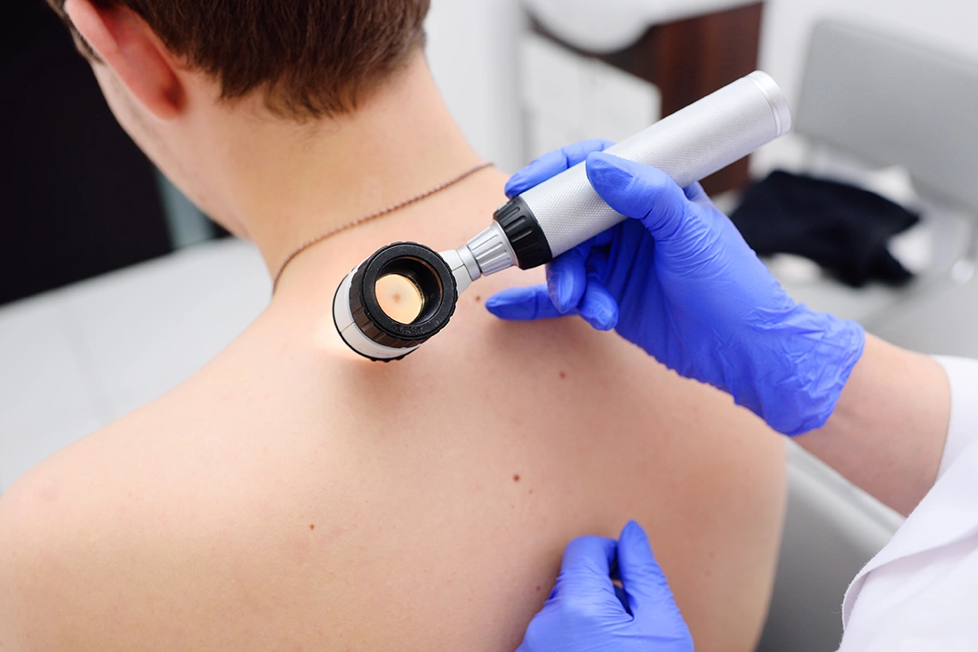 Medical professional using a dermatoscope to examine a patient’s skin mole during a clinical skin check.