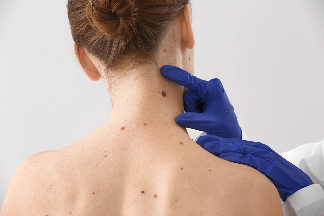 Doctor examining a patient’s moles, checking for signs of melanoma or other skin abnormalities.