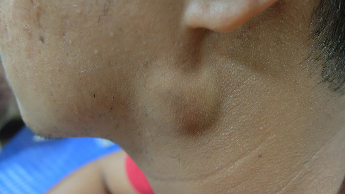 Close-up of a patient’s face with visible swelling in the preauricular area, consistent with parotid gland enlargement.
